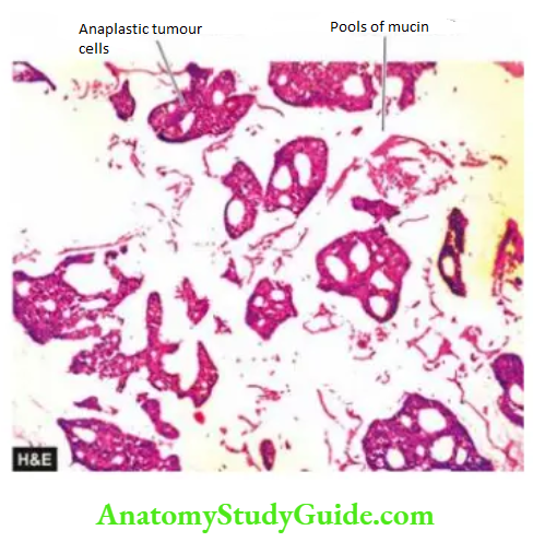 The Breast Colloid (mucinous) carcinoma breast.