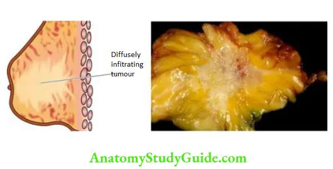 The Breast Invasive carcinoma, no special type (NST) (infiltrating duct carcinoma-NOS).