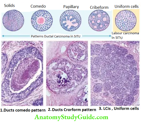 The Breast Morphologic patterns of carcinoma in situ (non-invasive carcinoma) of breast.