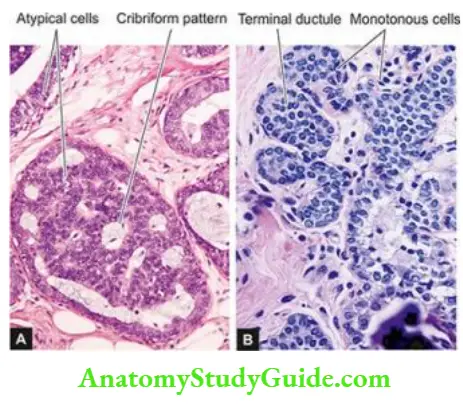 Pathology Of The Breast Notes - Anatomy Study Guide