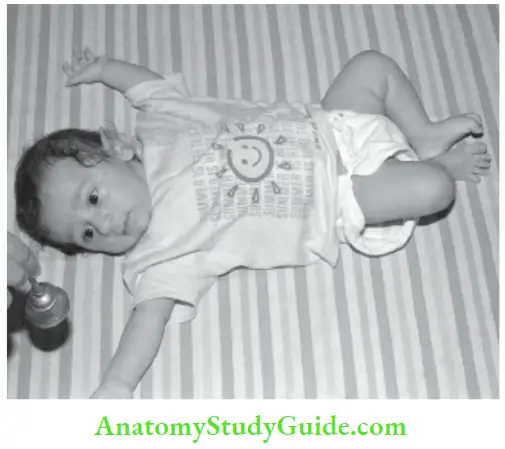 The Central Nervous System Assessment Of Hearing In An Infant With A Temple Bell