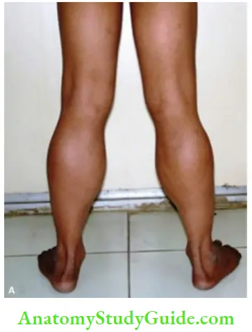 The Central Nervous System Bulky Calves Due To Pseudohypetrophy Of calf Muscles In An 8 year Old Boy Duchenne's Muscular Dystrophy