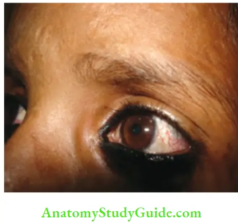 The Central Nervous System Conjunctival Telangiectasia In A Child With Ataxia Telangiectasia