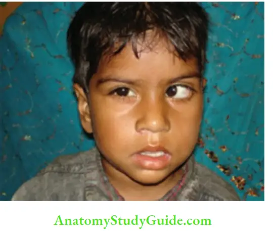 The Central Nervous System Paralytic Convergent Squint In A Child With Left Nerve Palsy