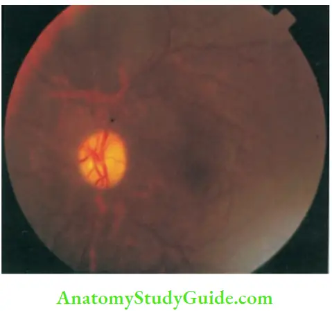 The Central Nervous System Post Papilledematous Optic Atrophy