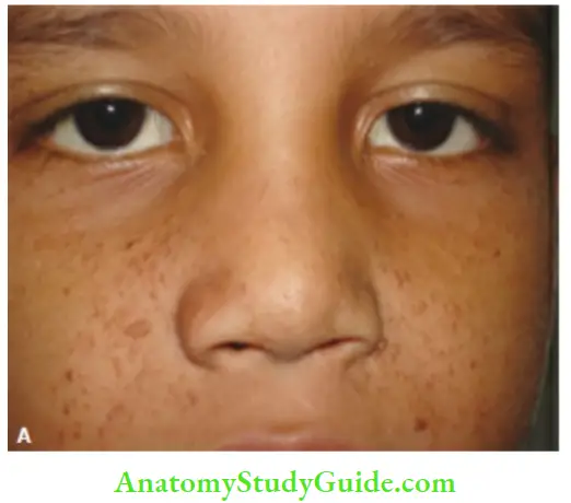 The Central Nervous System Typical Flesh Colored Papulonodular Skin Lesions Of Adenoma Sebaceum On The Cheeks Nose And Forehead