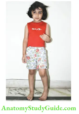 The Central Nervous System Typical Stance Of The Child With Hemiplegia On The left Side