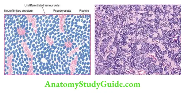 The Endocrine System Neuroblastoma.