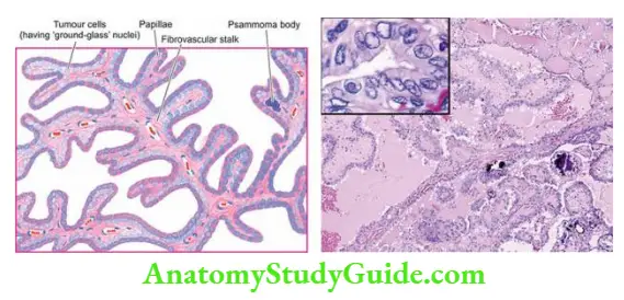 The Endocrine System Papillary thyroid carcinoma..