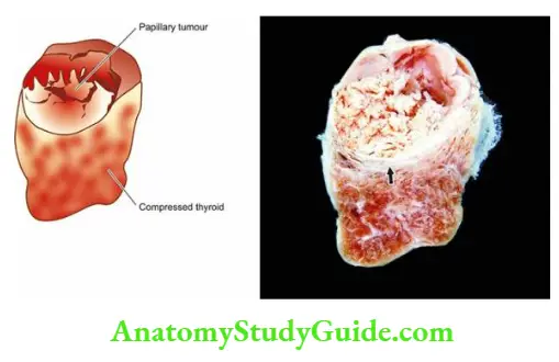 The Endocrine System Papillary thyroid carcinoma.