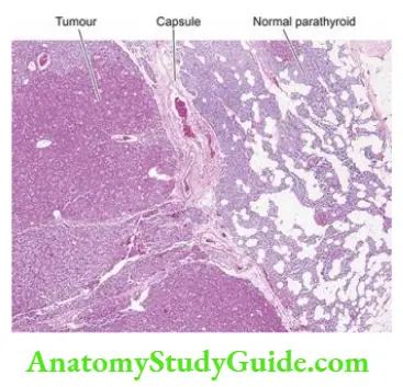 Parathyroid Glands: Diseases and Types - Anatomy Study Guide