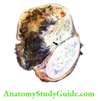 The Endocrine System Pheochromocytoma of the adrenal medulla.