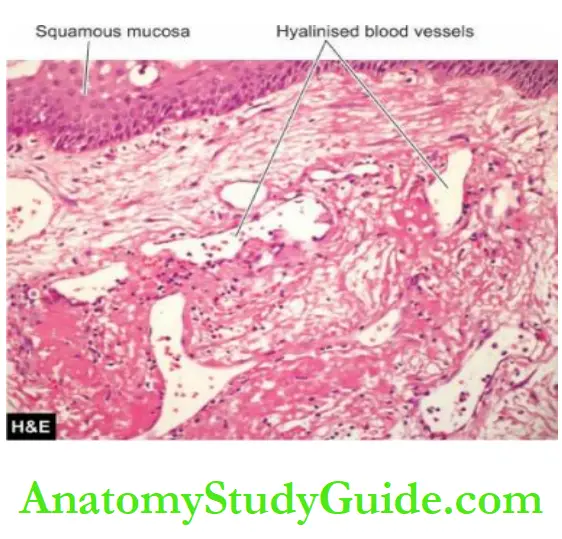 The Eye, ENT and Neck Lymphoepithelial (branchial) cyst