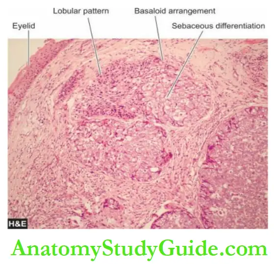 The Eye, ENT and Neck Sebaceous carcinoma.
