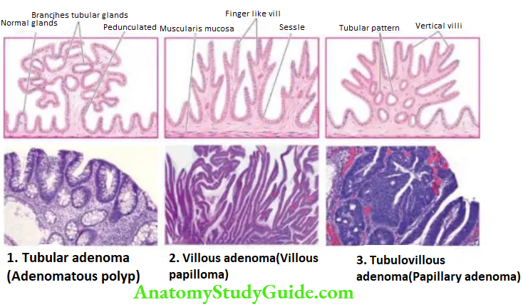 The Gastrointestinal Tract Adenomas (neoplastic polyps)—three main varieties