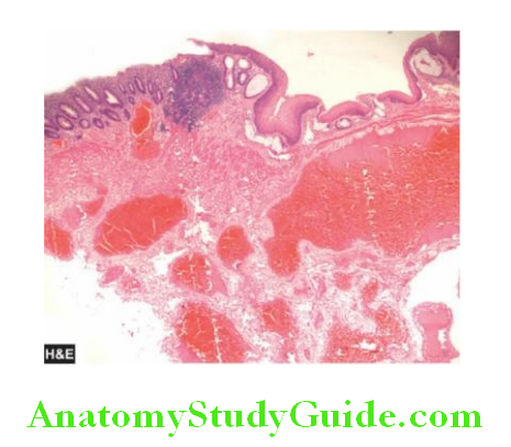 The Gastrointestinal Tract External piles