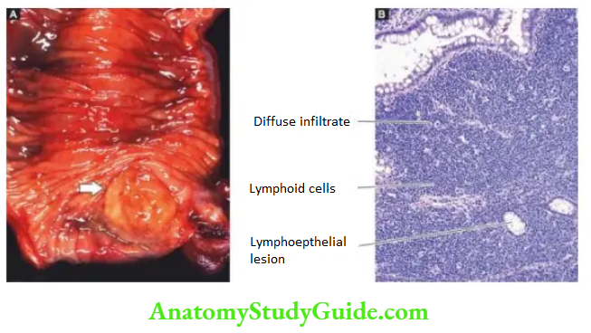 The Gastrointestinal Tract Lymphoma small intestine