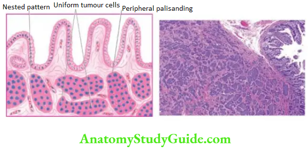 The Gastrointestinal Tract Microscopic appearance shows tumour infiltrating in the ileal wall