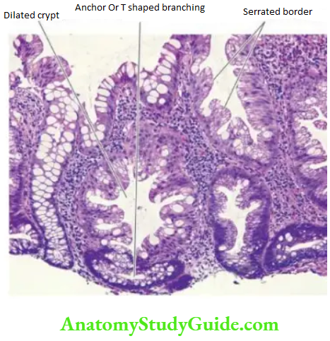 The Gastrointestinal Tract Sessile serrated adenoma polyp