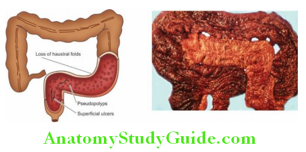 The Gastrointestinal Tract Ulcerative colitis