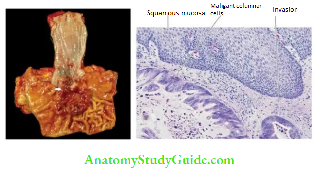 The Gastrointestinal Tract adenocarcinoma lower end oesophagus