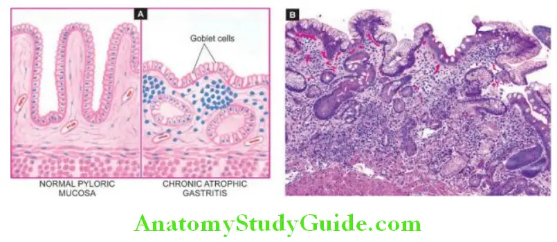 The Gastrointestinal Tract chronic atrophic gastritis right contrasted with normal pyloric mucosa left