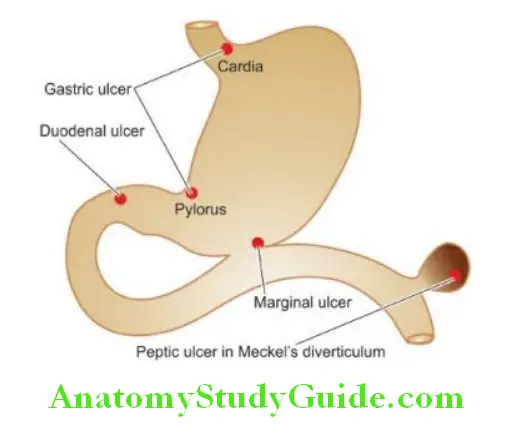 The Gastrointestinal Tract diatribution of peptic ulcers