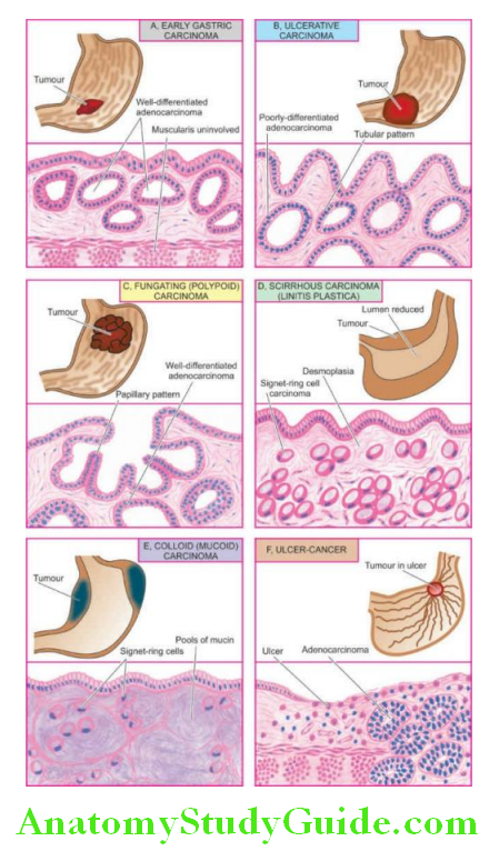 The Gastrointestinal Tract gastric carcinoma gross appearance of subtypes and thier corrsponding dominant histological patterns