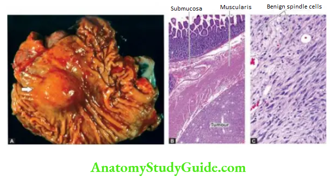 The Gastrointestinal Tract gastrointestinal stromal tumour