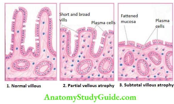 The Gastrointestinal Tract jejunal biopsy diagrammatic appearance in malabsorption syndrome