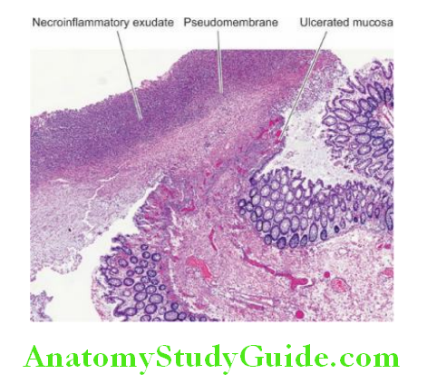 The Gastrointestinal Tract pseudomembranous colitis