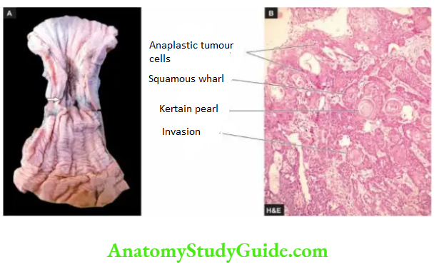 The Gastrointestinal Tract squamous cell carcinoma oesophagus
