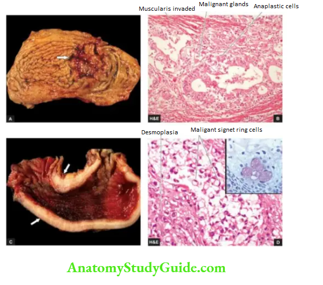 The Gastrointestinal Tract ulcerative carcinoma sromach