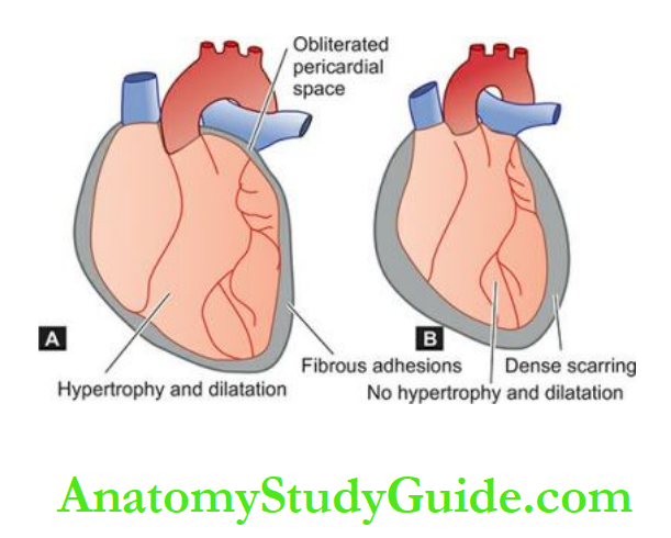 The Heart Appearance of the heart and the pericardium in chronic adhesive