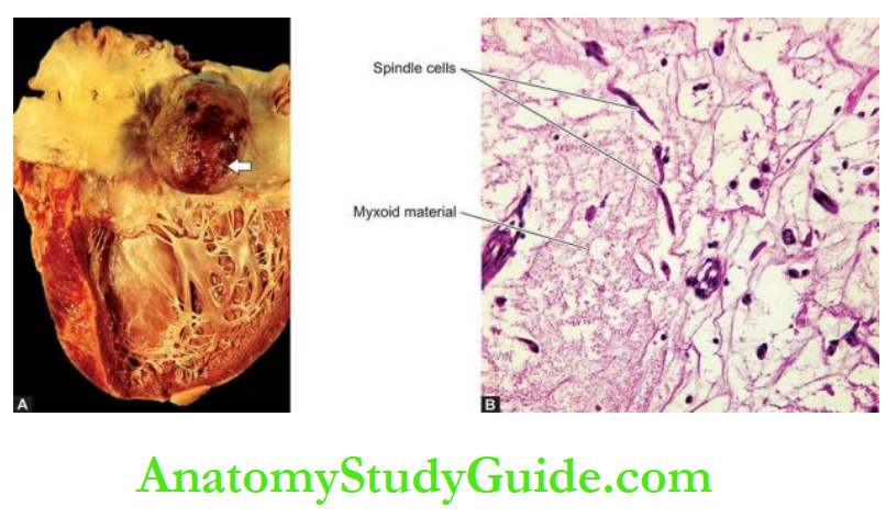 The Heart Atrial myxoma