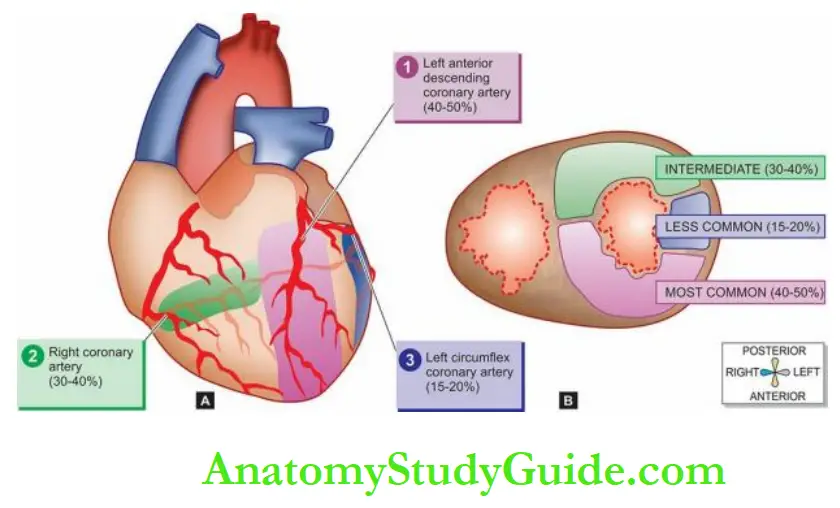 The Heart Common locations and the regions of involvement in myocardial infarction.