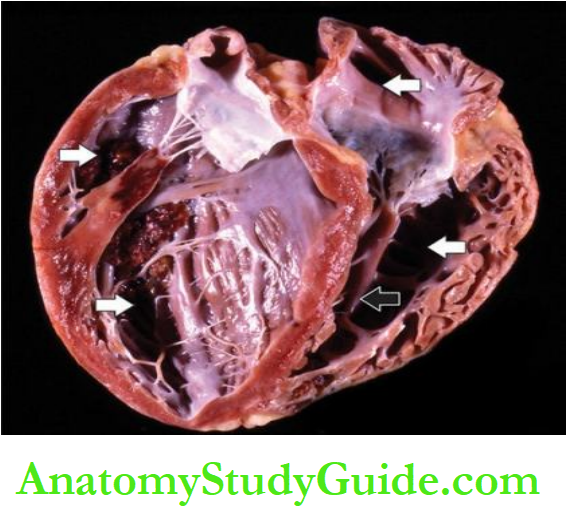 The Heart Dilated cardiomyopathy.