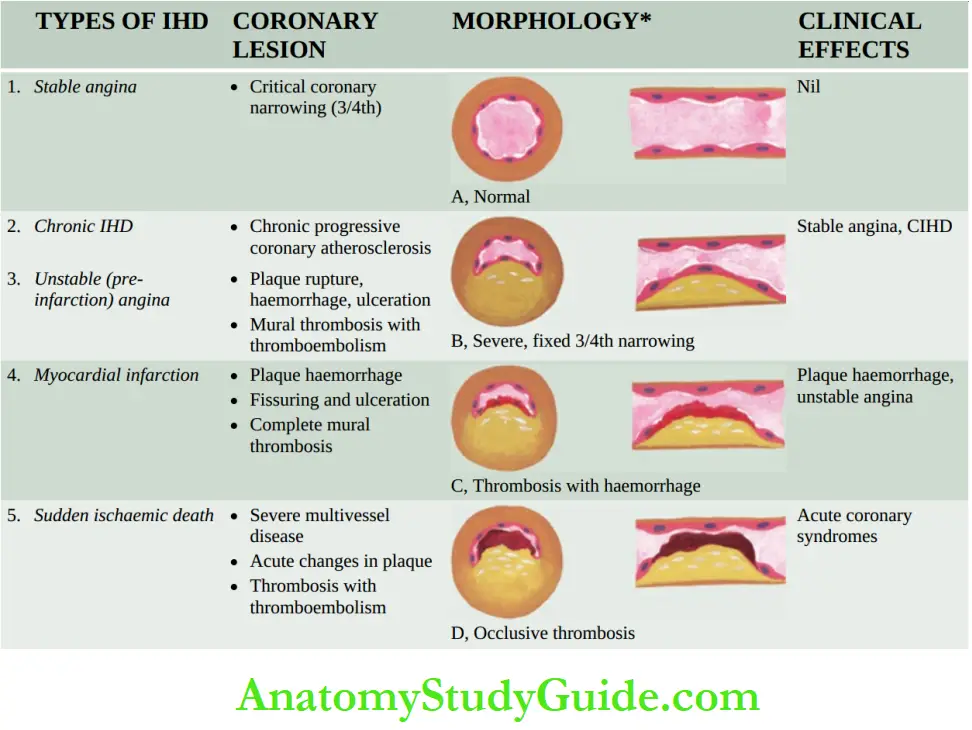 The Heart Lesions in coronary artery in various forms of IHD.