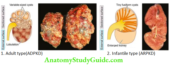 The Kidney and Lower Urinary Tract Adult (autosomal dominant) polycystic kidney disease (ADPKD), bilateral kidneys.
