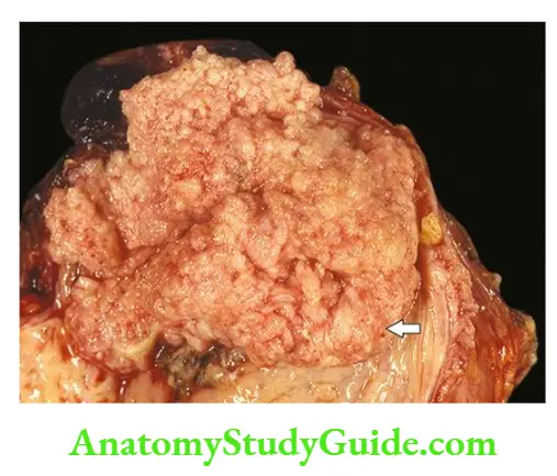 The Kidney and Lower Urinary Tract Carcinoma urinary bladder.