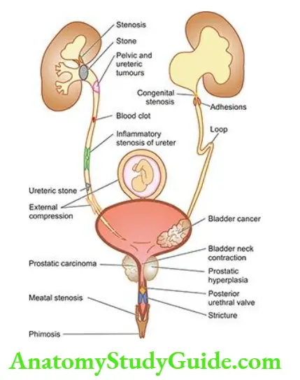 The Kidney and Lower Urinary Tract Causes of obstructive uropathy at different levels in the urinary