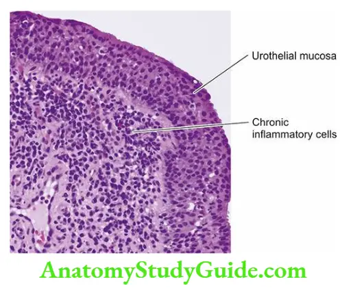 The Kidney and Lower Urinary Tract Chronic cystitis.
