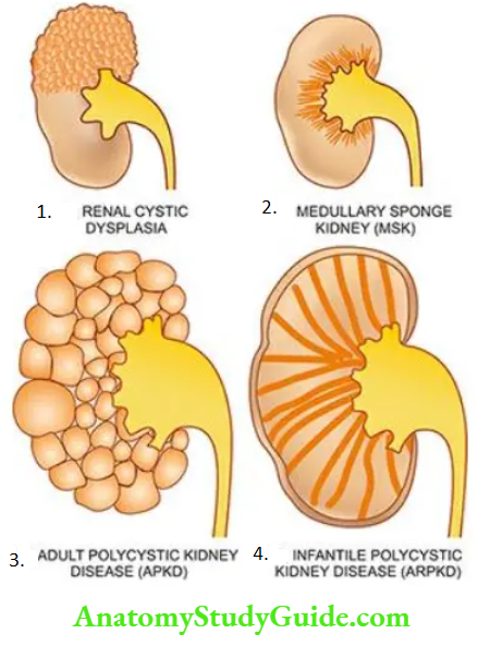 The Kidney and Lower Urinary Tract Cystic diseases of kidney