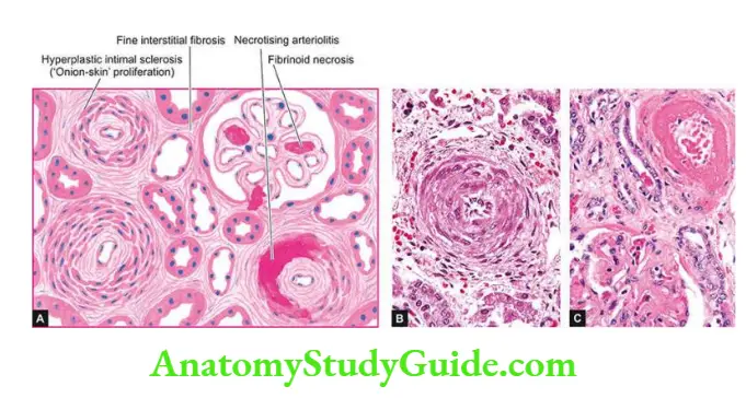 The Kidney and Lower Urinary Tract Malignant nephrosclerosis.