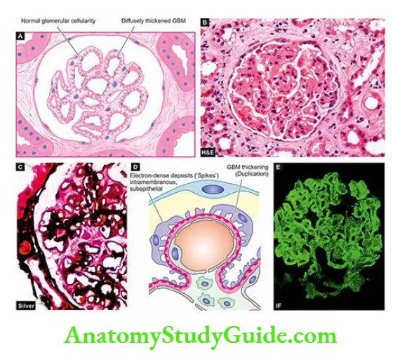 The Kidney and Lower Urinary Tract Membranous GN.