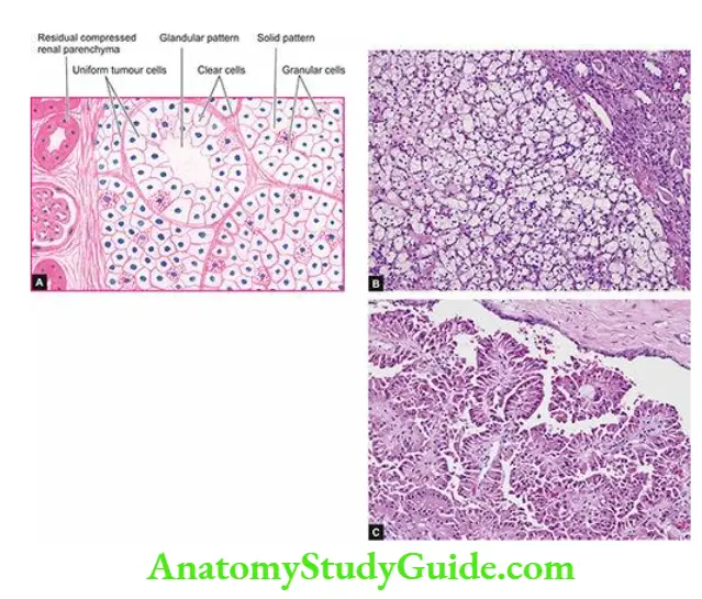 The Kidney and Lower Urinary Tract Renal cell carcinoma (RCC).
