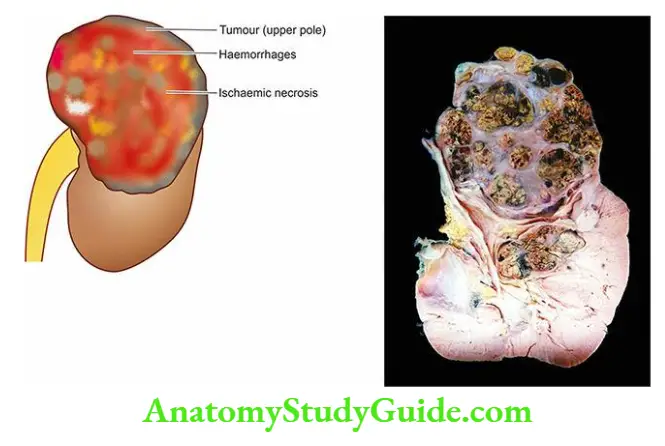 The Kidney and Lower Urinary Tract Renal cell carcinoma.