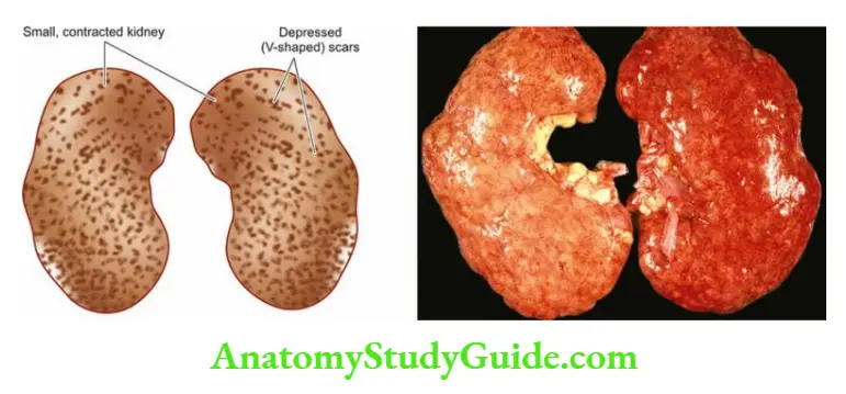 The Kidney and Lower Urinary Tract Small, contracted kidneys in chronic hypertension (benign nephrosclerosis). The kidneys are small and contracted.