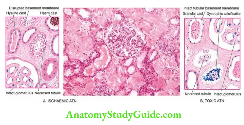 The Kidney and Lower Urinary Tract Types of ATN.