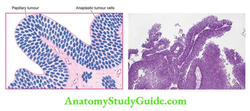 The Kidney and Lower Urinary Tract Urothelial (Transitional cell) carcinoma, high grade.
